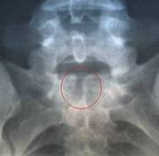  Рентгенограмма при Spina bifida (Спина бифида)